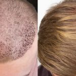 Методы пересадки волос FUT: подробный обзор и особенности процедуры